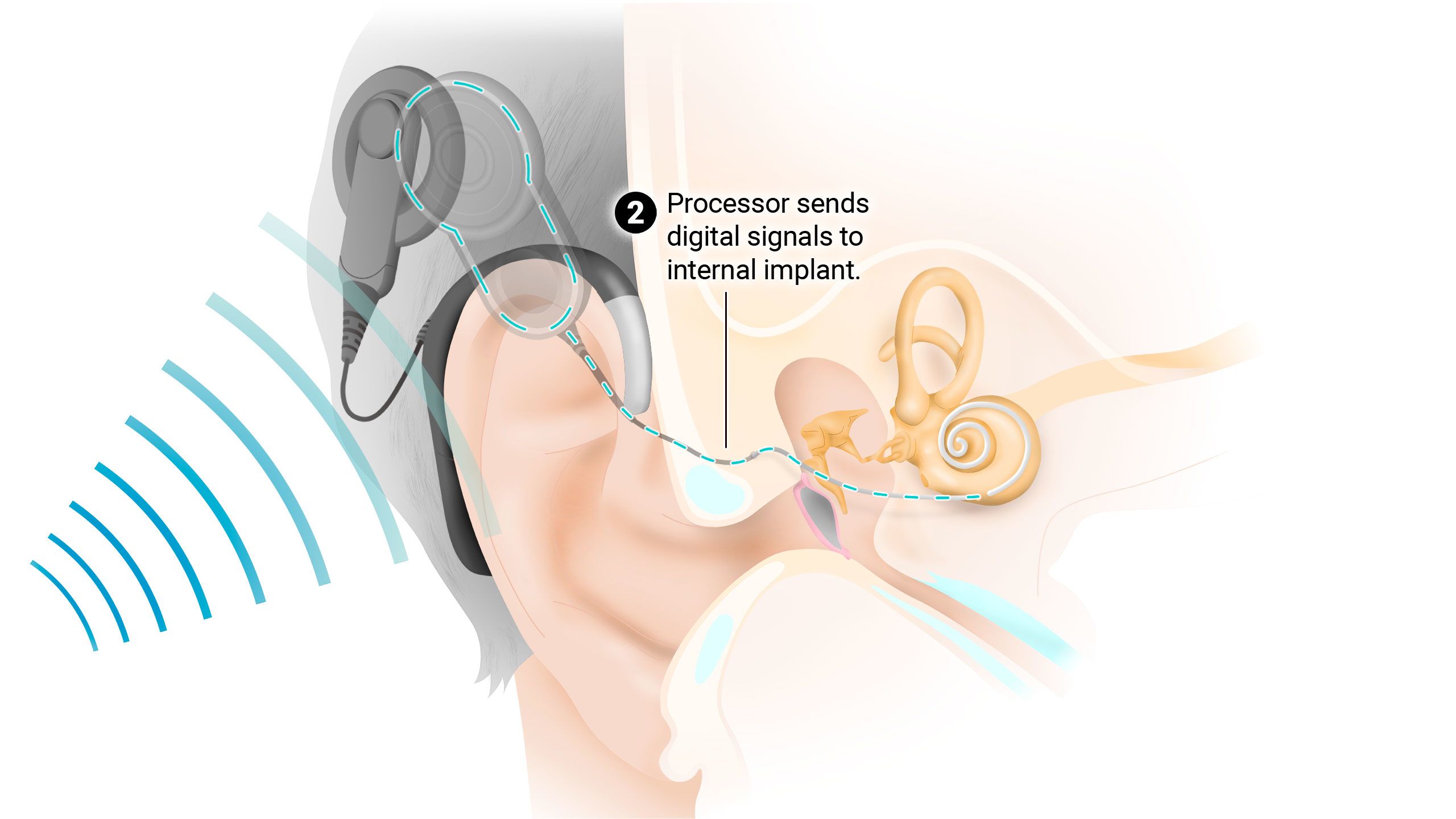Processor sends digital signals to internal implant.