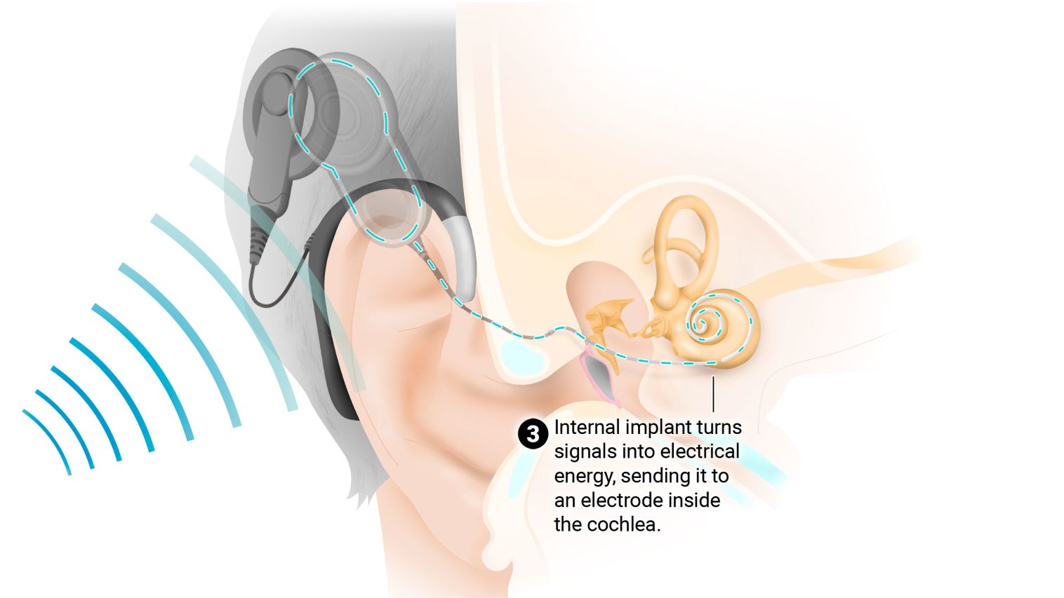 Wireless Cochlear Testing Living in silence: Losing your hearing is frightening, frustrating and ...