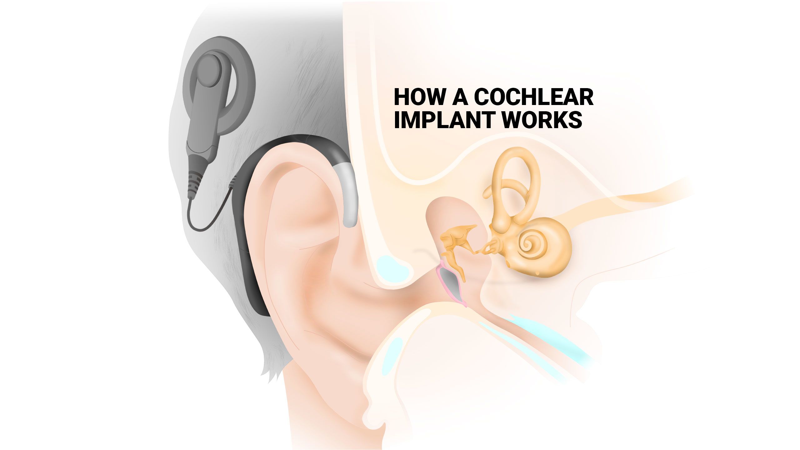 How a cochlear implant works.