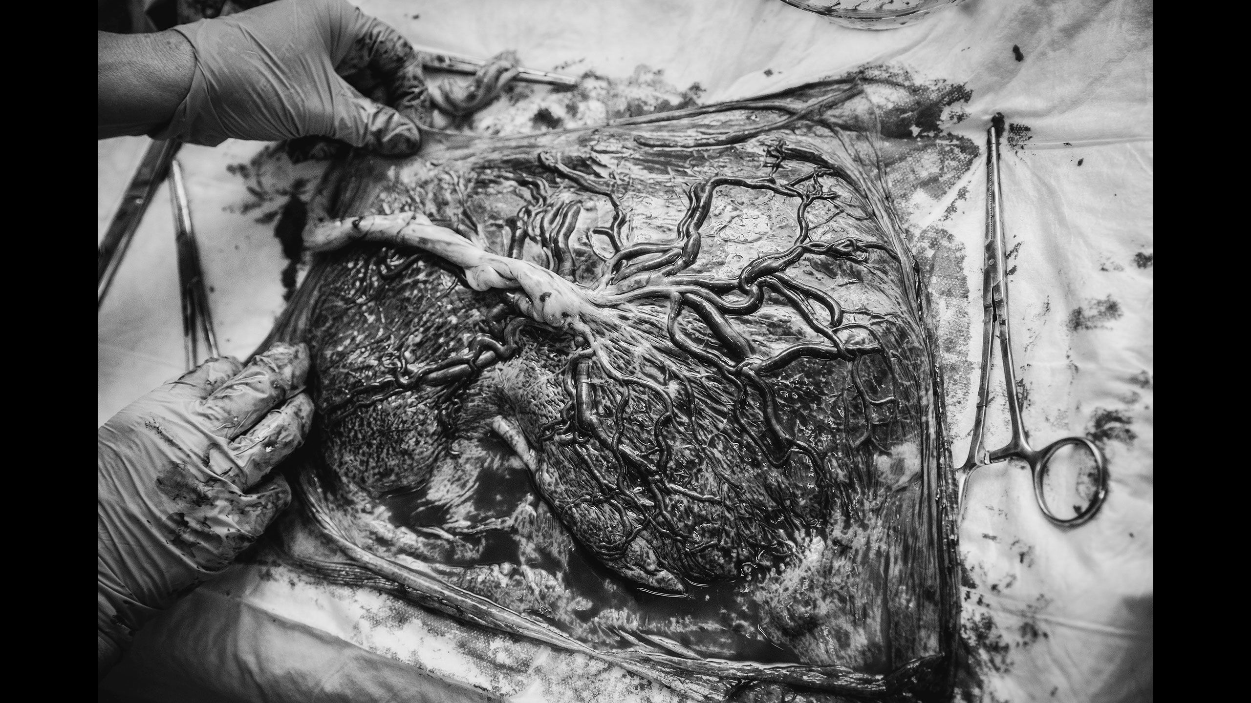 A close-up image of the surgeon inspecting the placenta.